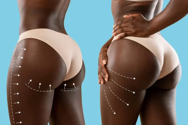Brazilian Butt Lift (BBL) in South Africa
